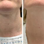 Best Doctors in dubai for Radiant Skin Using Radiofrequency Microneedling