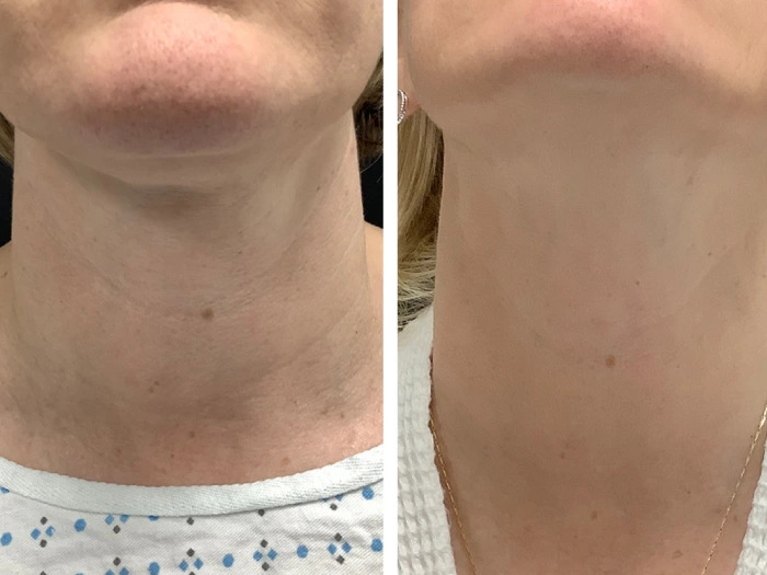 Best Doctors in dubai for Radiant Skin Using Radiofrequency Microneedling