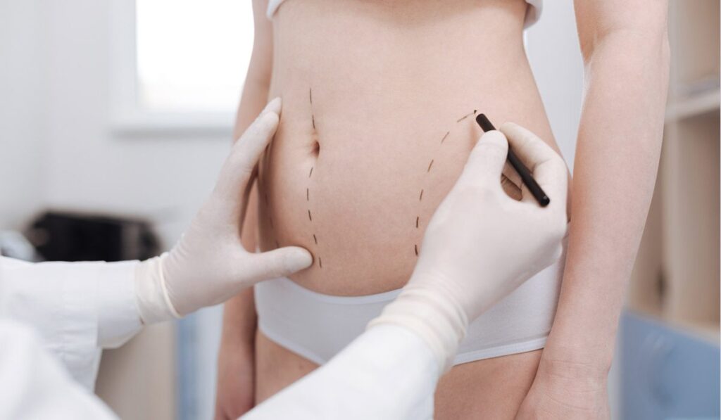 Liposuction in Dubai