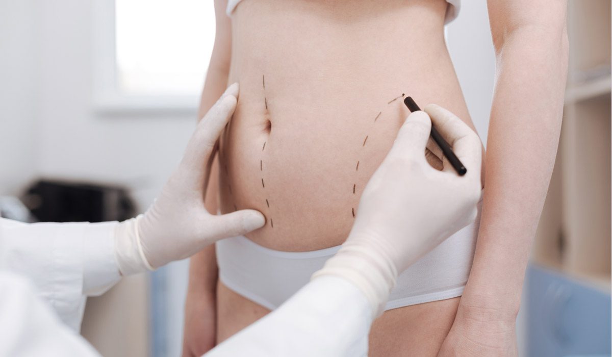 Liposuction in Dubai