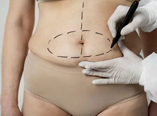 Tummy Tuck in Dubai