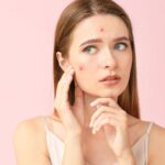 Acne Treatment in Dubai: How to Prepare for Your First Consultation
