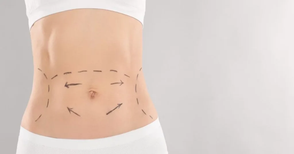How Tummy Tuck in Dubai Creates a More Defined Abdomen
