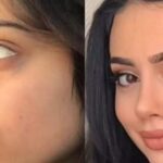 Rhinoplasty in Dubai