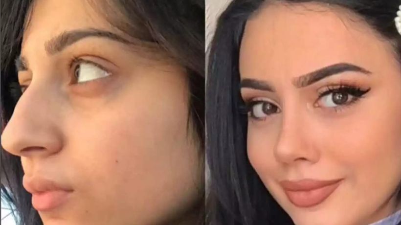 Rhinoplasty in Dubai