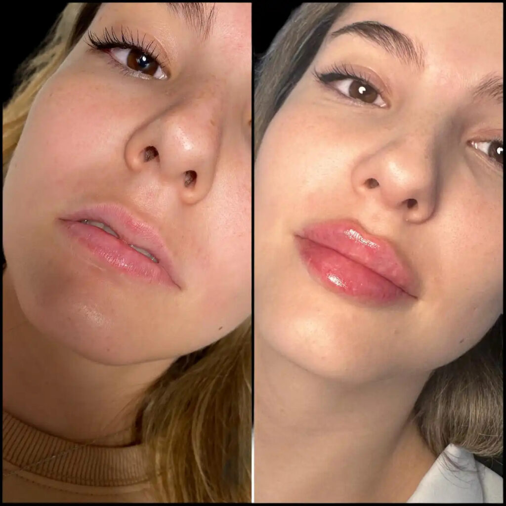 Fillers in Dubai