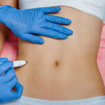 Intimate Area Fillers Dubai