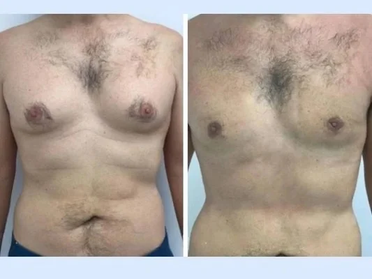 Best Doctors in Dubai for Gynecomastia: Finding the Right Surgeon