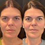 Natural Thread lift treatments in Dubai: Subtle Elegant Beauty Enhancement for Facial Rejuvenation