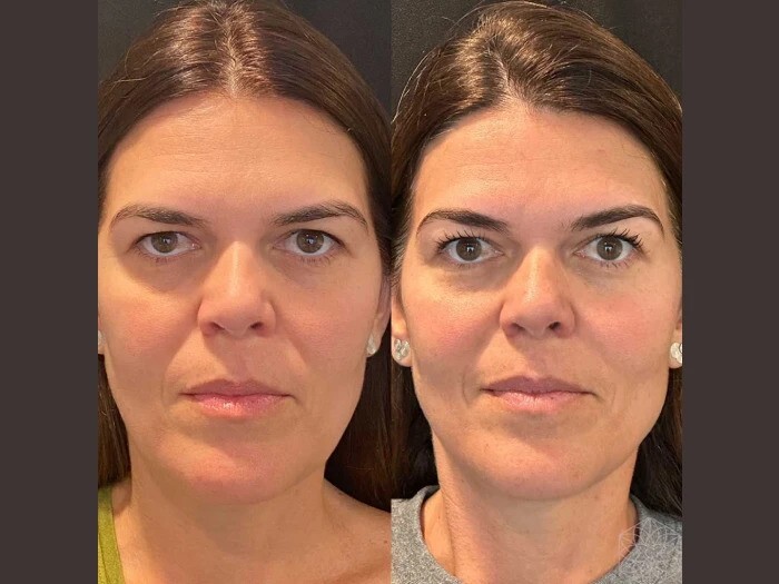 Natural Thread lift treatments in Dubai: Subtle Elegant Beauty Enhancement for Facial Rejuvenation