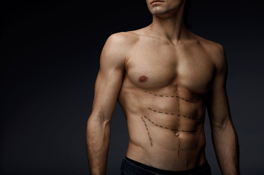 360 Liposuction Dubai: How Are Treatment Areas Selected for Body Contouring?