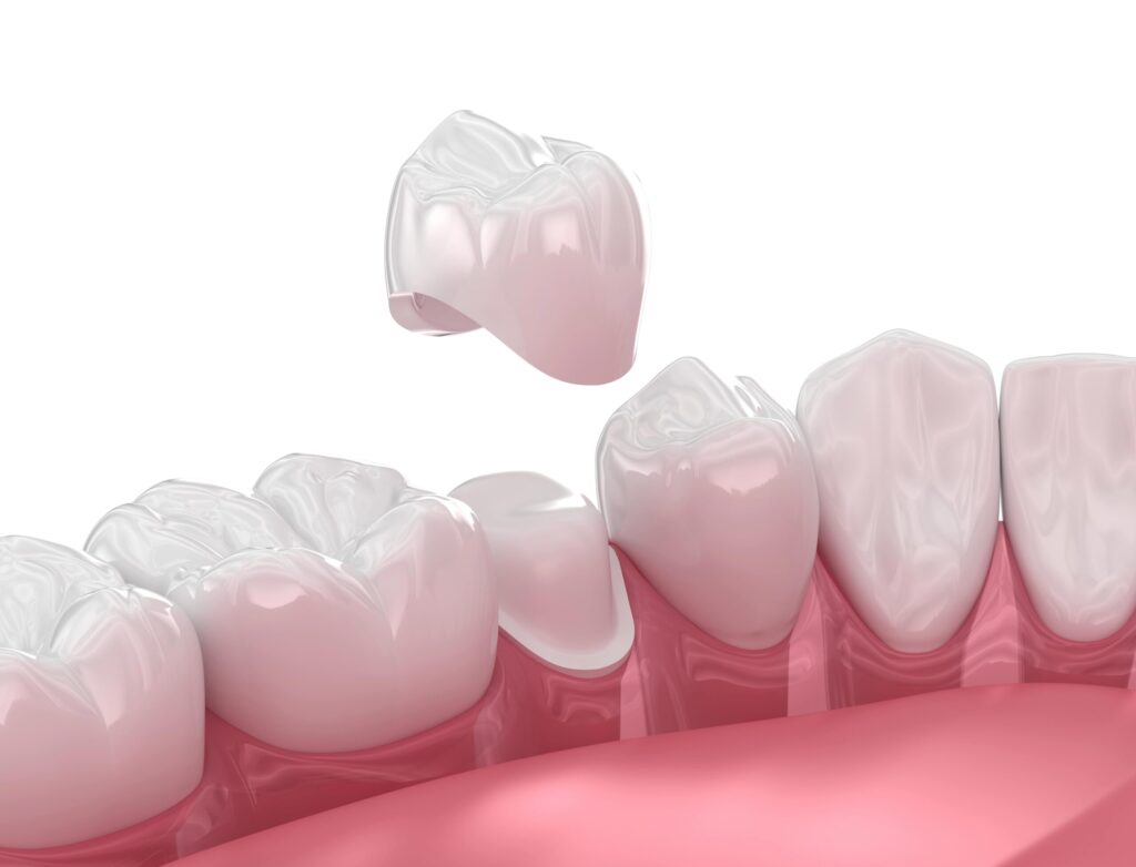 Dental Crown Dubai: How Is Crown Shape Matched to Your Smile?