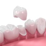 Dental Crown Dubai: How Is Crown Shape Matched to Your Smile?