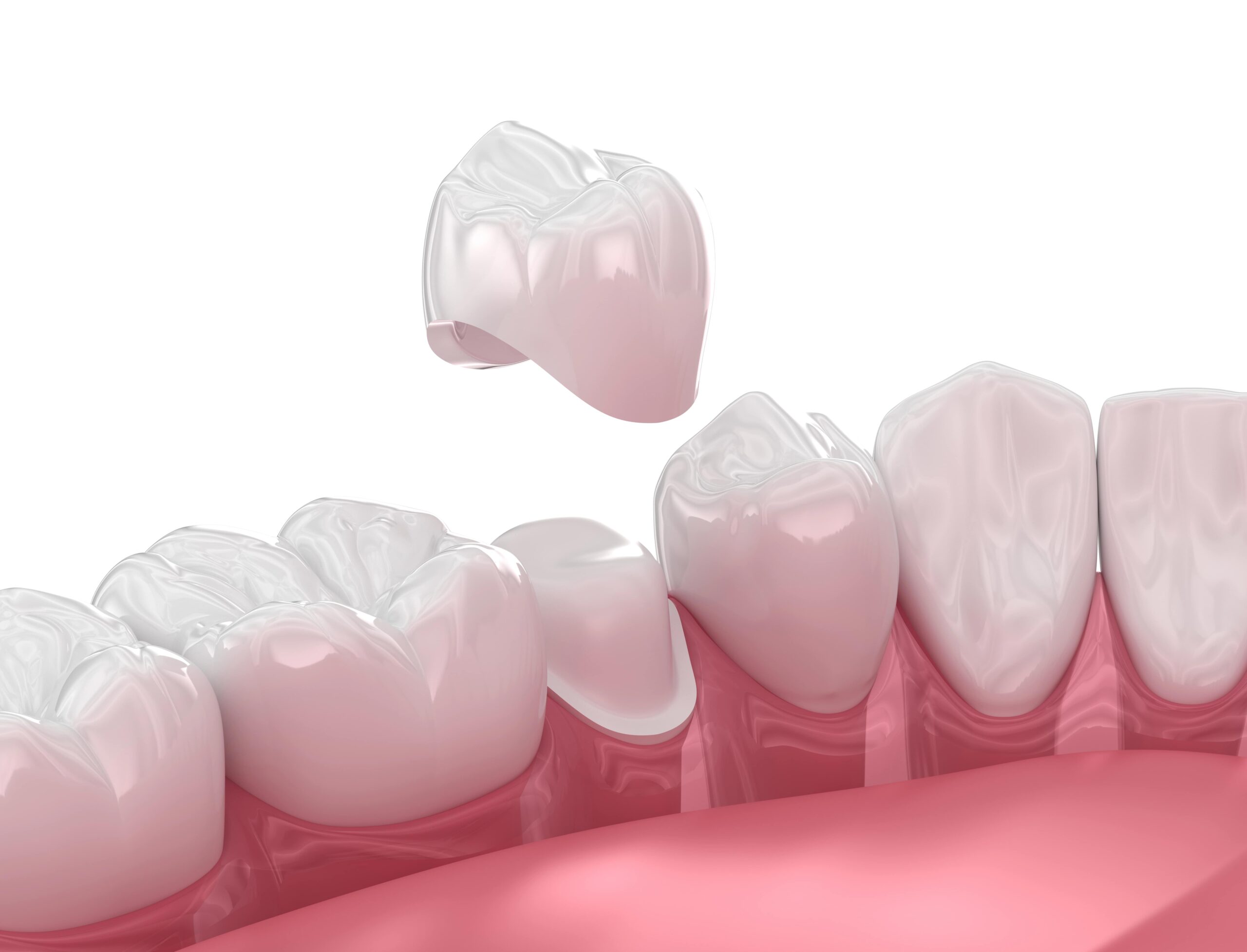 Dental Crown Dubai: How Is Crown Shape Matched to Your Smile?