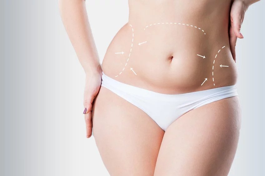 Liposuction Dubai: How Are Different Liposuction Areas Prioritised in a Treatment Plan?