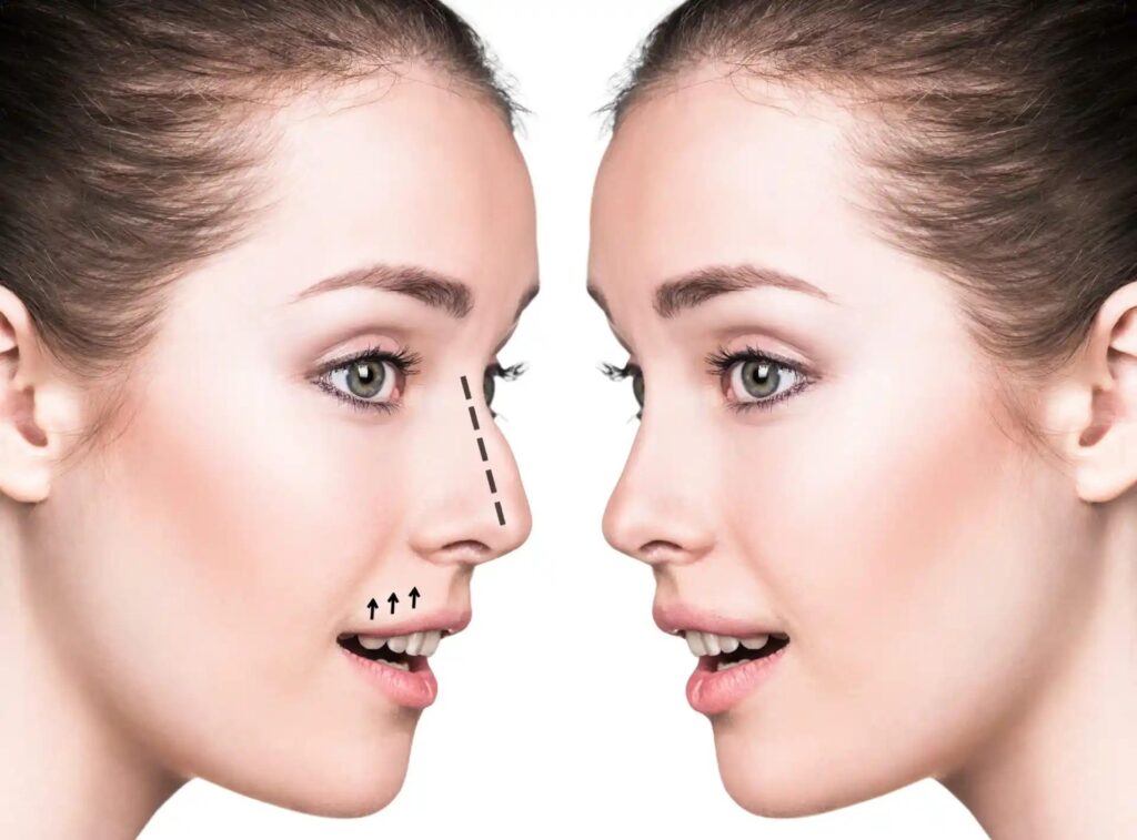 rhinoplasty in dubai