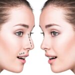 rhinoplasty in dubai