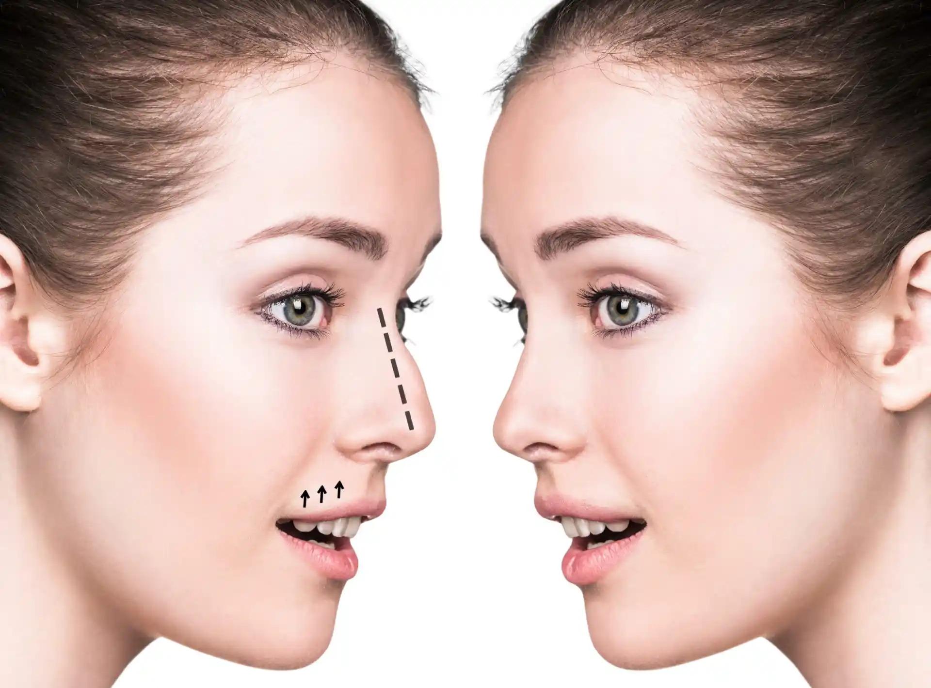 rhinoplasty in dubai